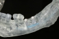 Preview: Unterkiefer - Demomodell mit Implantaten und Knochengitter
